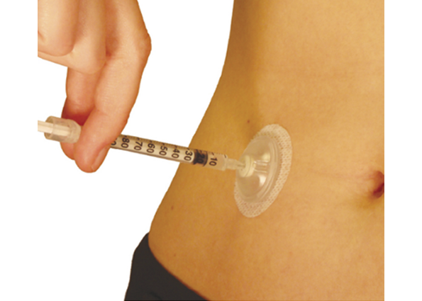 port d’injection Minimed i-Port Advance™