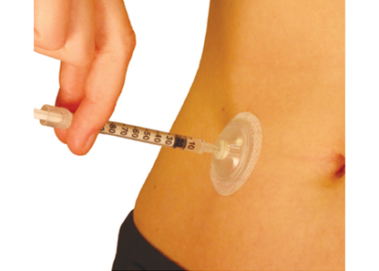 port d’injection Minimed i-Port Advance™
